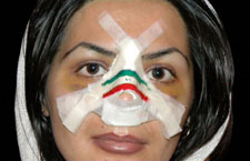 Irán orrműtétek, évente 60 ezer ember
